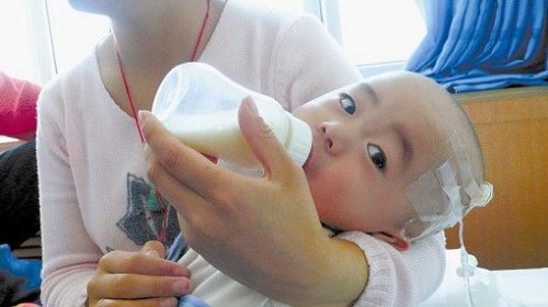 Chinese baby with kidney stones due to drinking Sanlu baby milk powder with melamine.