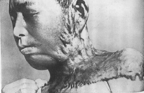 Japanese Atomic Bomb Victim Photos, Chinese Reactions