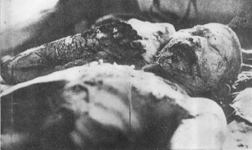 atomic bomb victims. Japanese Atomic Bomb Victim
