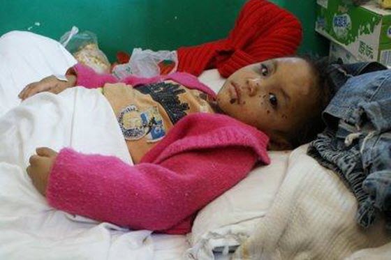 A 3-year-old Yunnan Chinese girl is in the hospital after suffering long-term child abuse living with her aunt while her parents were away working to make money.