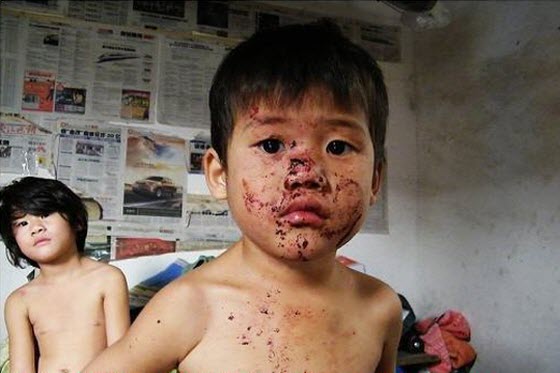 In Ningbo, China, two young children covered with fresh bloody injuries and old scars are rescued from their abusive father. Hungry, they haven't eaten in days.