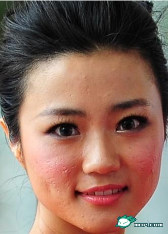 Close-up photo of Kong Yansong, revealing poor skin.